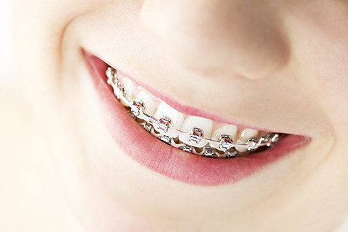 Dental Braces in rego Park, NY