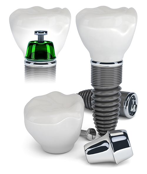 Dental Implants in Queens, NY