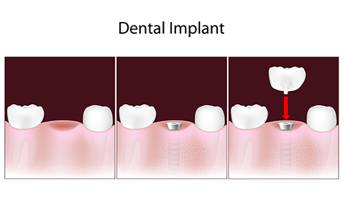Dental Implants Rego Park, NY