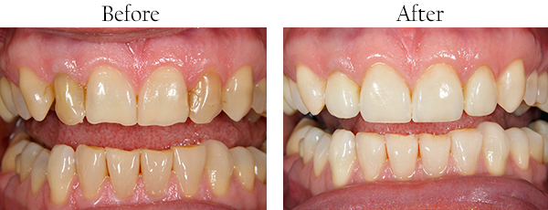 Dental Bleaching in Rego Park, NY