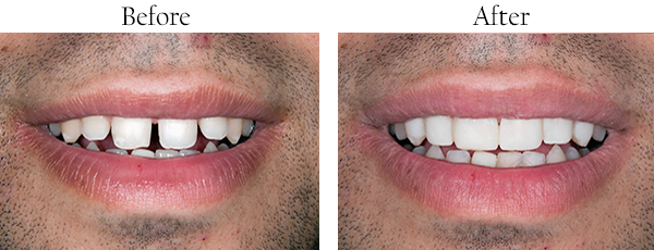 Cosmetic Dental Procedures in Rego Park, NY